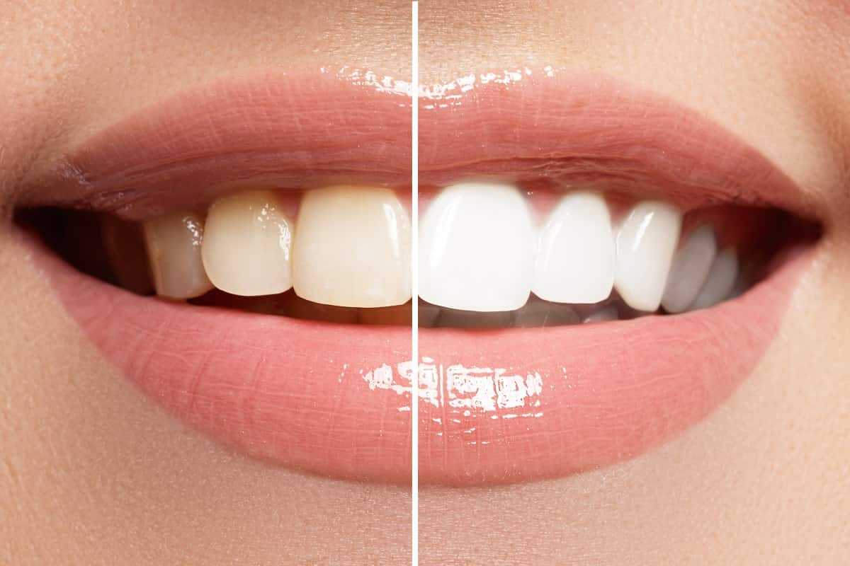 Evde bu 3 yöntemle inci gibi dişlere sahip olmak mümkün: Doğal diş beyazlatma yöntemleri!